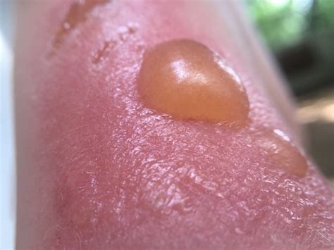 why is my sunburn leaking yellow|Sun Blister: Symptoms, Causes, Diagnosis, and。